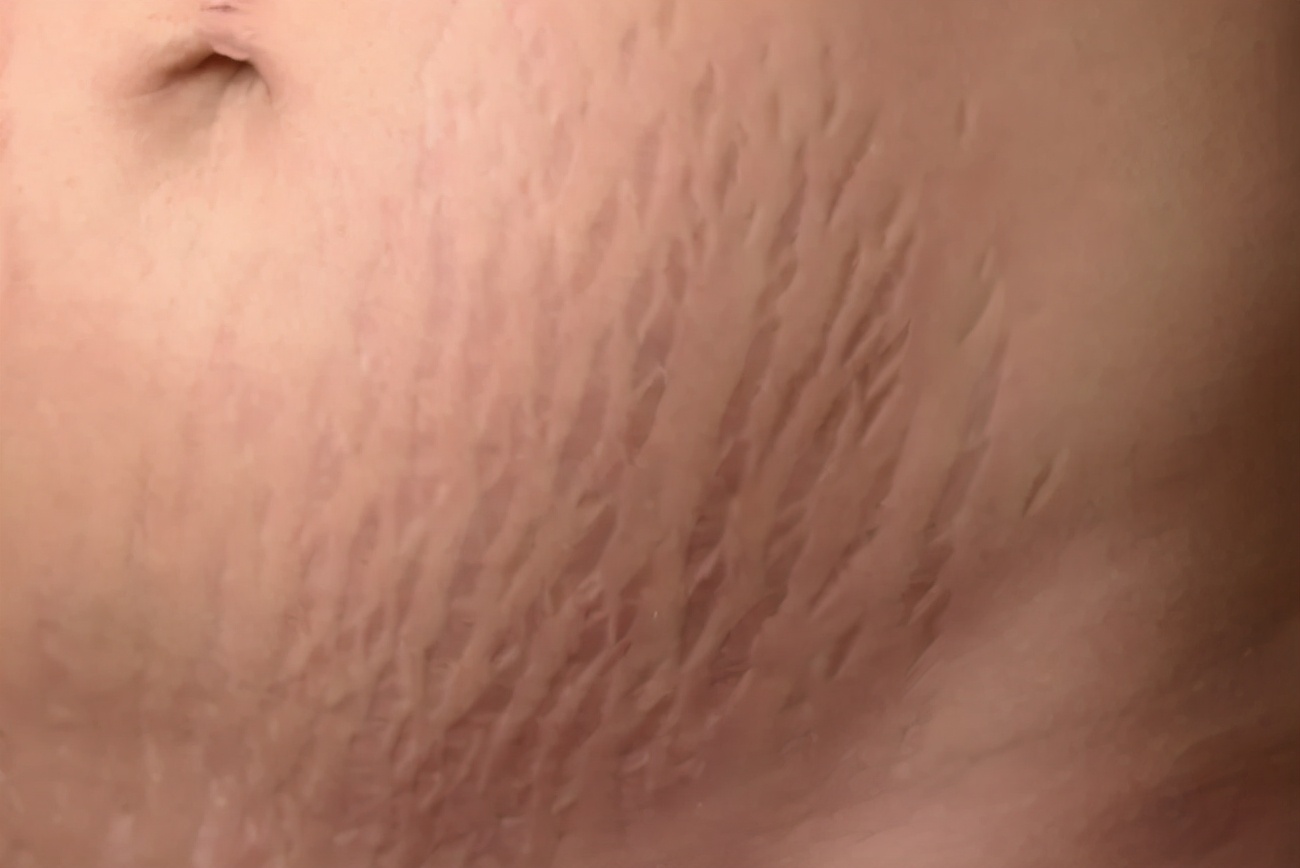 中医药对付妊娠纹,妊娠纹预防最有效的方法