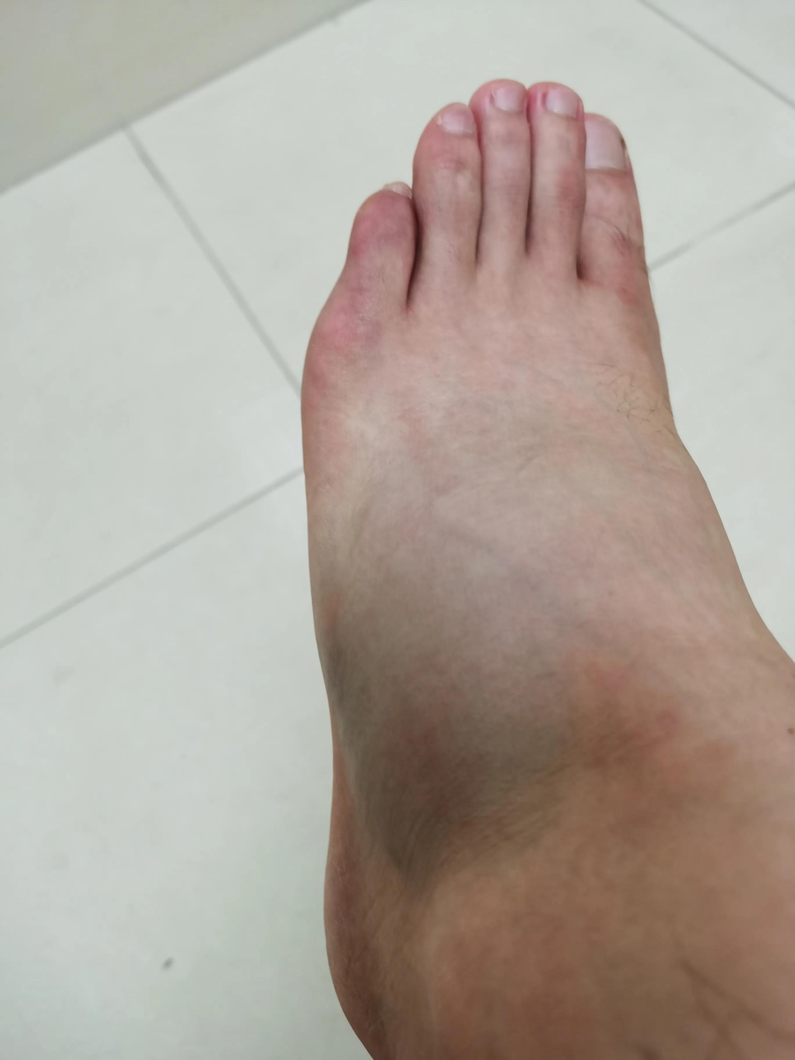 第五跖骨粉碎性骨折多久后能走路,第五跖骨基底骨折100天了走路肿