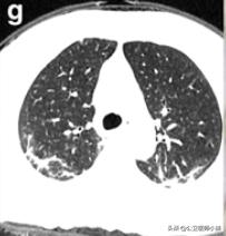新型冠状病毒感染的肺炎患者肺部影像学改变