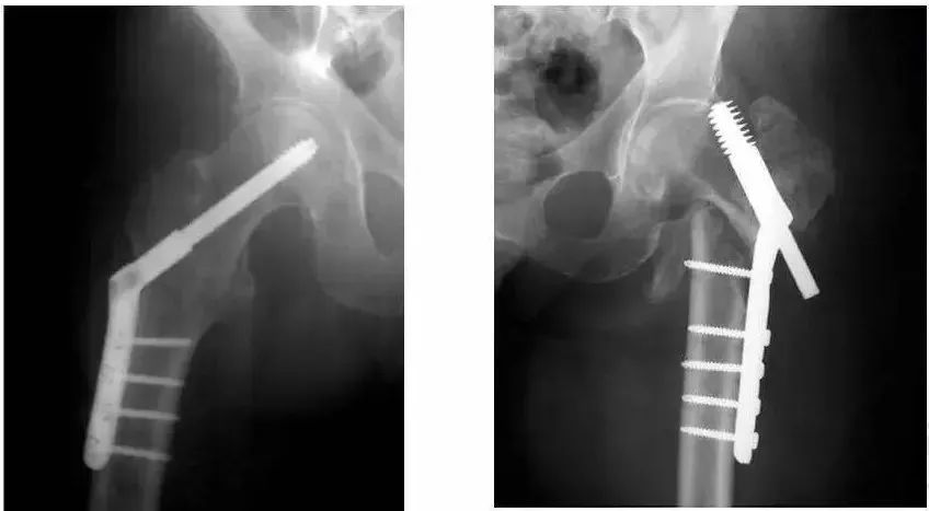 老人髋部骨折多长时间恢复到正常,老年人骨折无法固定怎么办