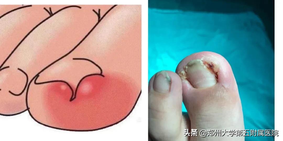 小孩怎么预防嵌甲,怎么预防嵌甲和甲沟炎