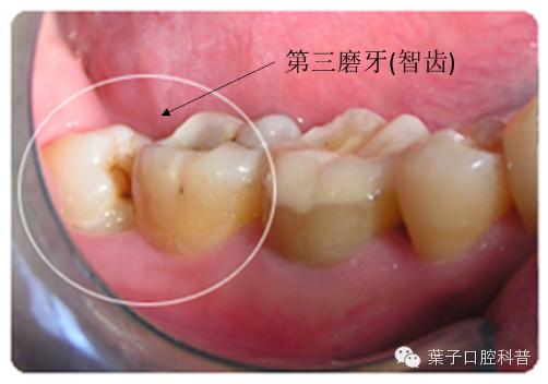 拔智齿十大危害,拔智齿利与弊