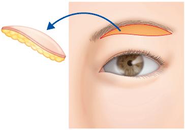 与大家聊一聊的技巧,做提眉手术后应该注意哪些事项