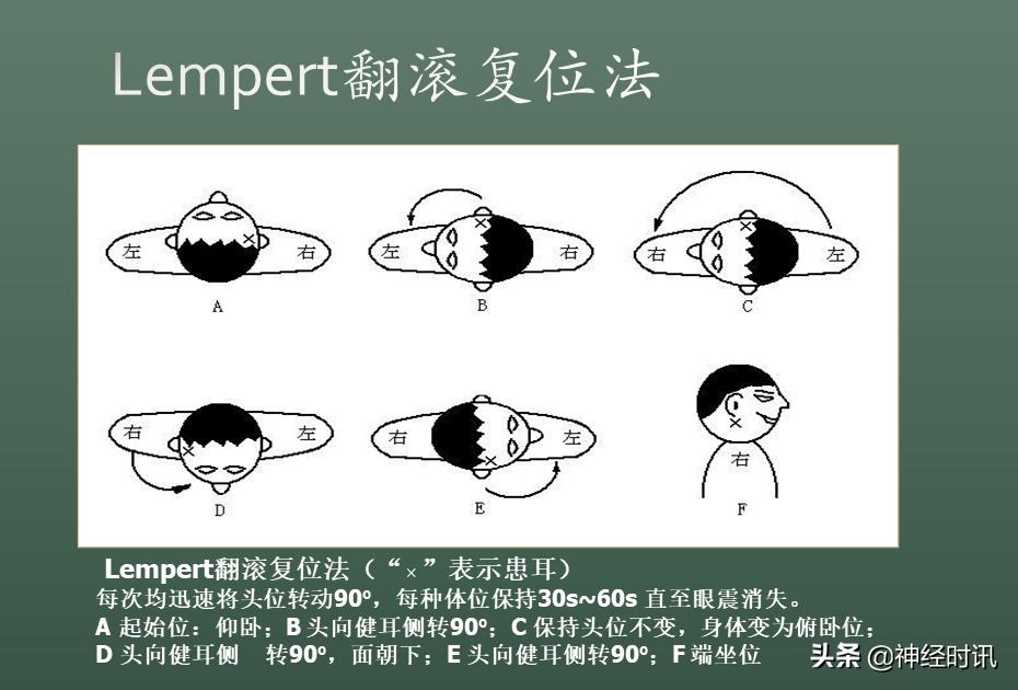 良性位置性眩晕诊断和治疗指南,良性阵发性位置性眩晕的诊断标准