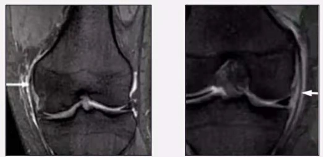 膝关节内侧副韧带损伤症状,膝关节副韧带损伤恢复训练
