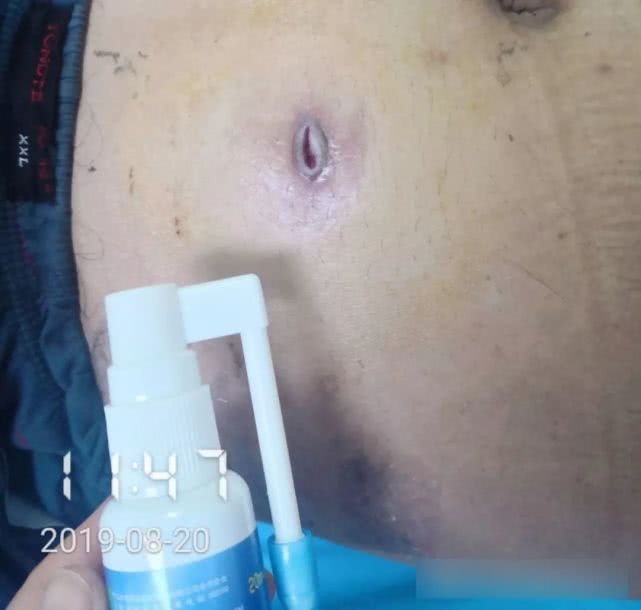 阑尾炎形成窦道的原因,阑尾炎一孔微创手术全过程