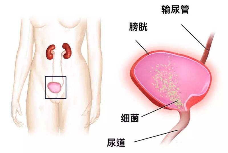 女人会尿频尿急尿不尽吗,女性会尿频尿急尿不尽吗