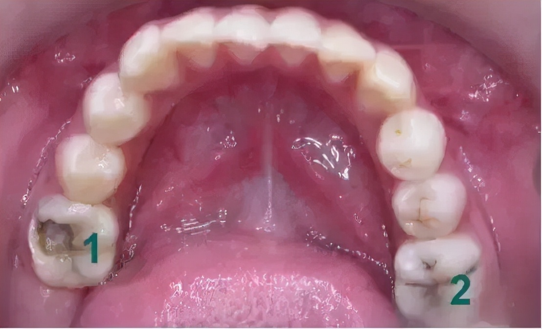 6-12岁儿童换牙的顺序图片,6-12岁换牙的顺序