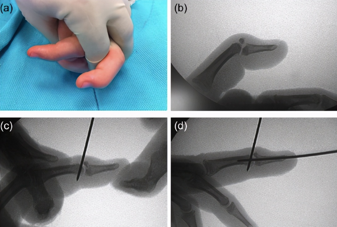 打篮球时手指戳到球了该怎么办,手指被篮球戳了怎么一直疼