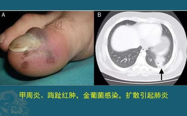 化脓性细菌感染用什么抗生素,化脓性细菌感染有痰用什么抗生素