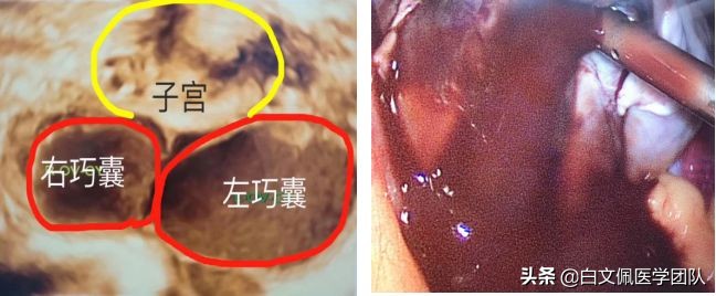 腹腔镜妇科解剖教学视频教程,白文佩医学团队