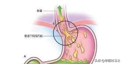 反流性食管炎用什么中药能治,反流性食管炎常用药