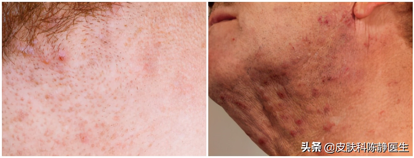 刮胡子毛囊炎凸起硬疙瘩怎么消除,刮胡子起小红点的毛囊炎怎么办