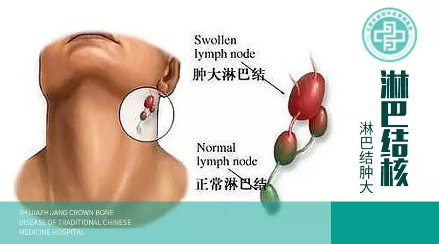 淋巴结核导致淋巴癌可能性,淋巴结核严重了会致命吗
