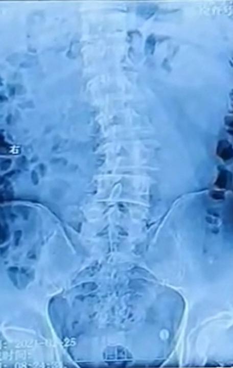 腰椎退变侧弯是什么意思,年轻人腰椎退行性改变是怎么回事