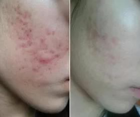 点阵激光祛痘印的副作用和危害,co2点阵激光危害