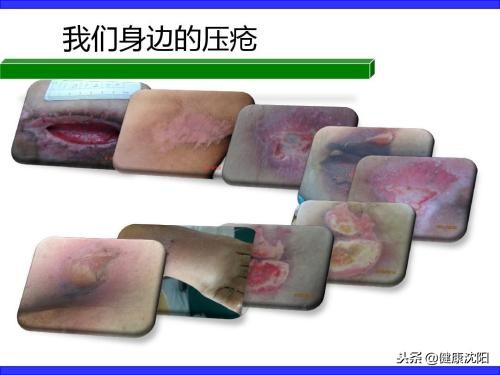 世界压疮预防日,预防压疮和护理压疮