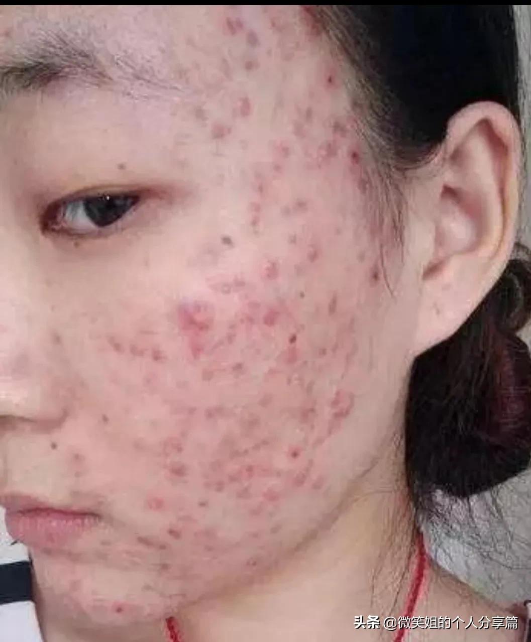 脑门一直长闭口长痘什么原因,人中长痘闭口怎么办