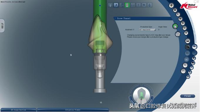 展评优秀病例赏析|Asc全瓷角度基台一体冠进行种植前牙美学修复