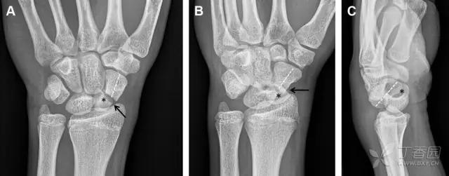 放射科夜班病例大全,放射科容易漏诊的骨折