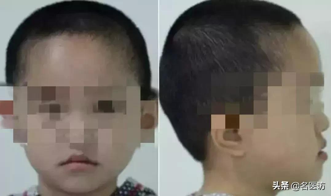 地包天早期矫正最佳时间,地包天最佳矫正时间及方法