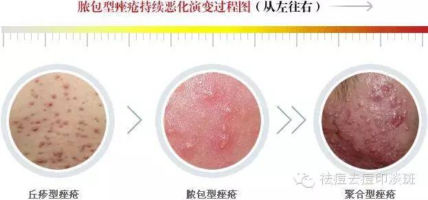 脸上痘痘黑色硬痛是炎症性丘疹,炎症性痘痘是因为什么原因长的