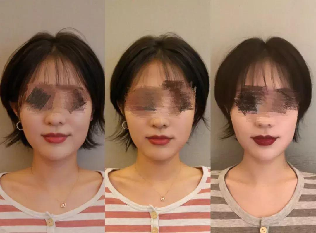 日式小颜整骨合法吗,日式小颜整骨可以维持多久