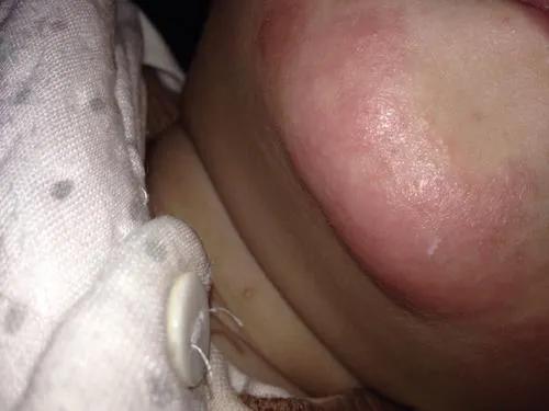 宝宝脸上爱长湿疹,宝宝脸上的湿疹反复发作怎么办