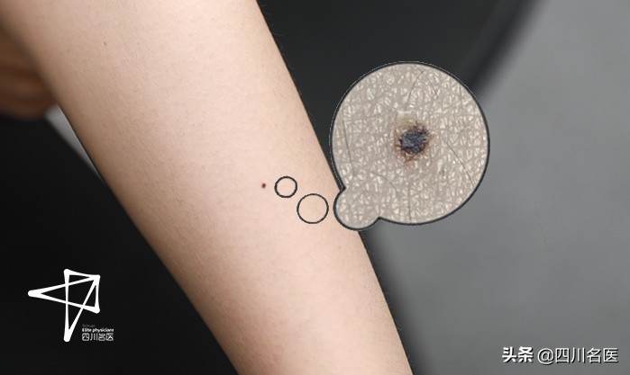 肉痣在癌变之前切除,凸起的黑色痣会癌变会怎样