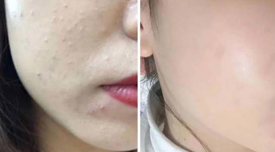 女生闭口痘痘怎么处理好得快,女生脸上有闭口痘痘怎么解决