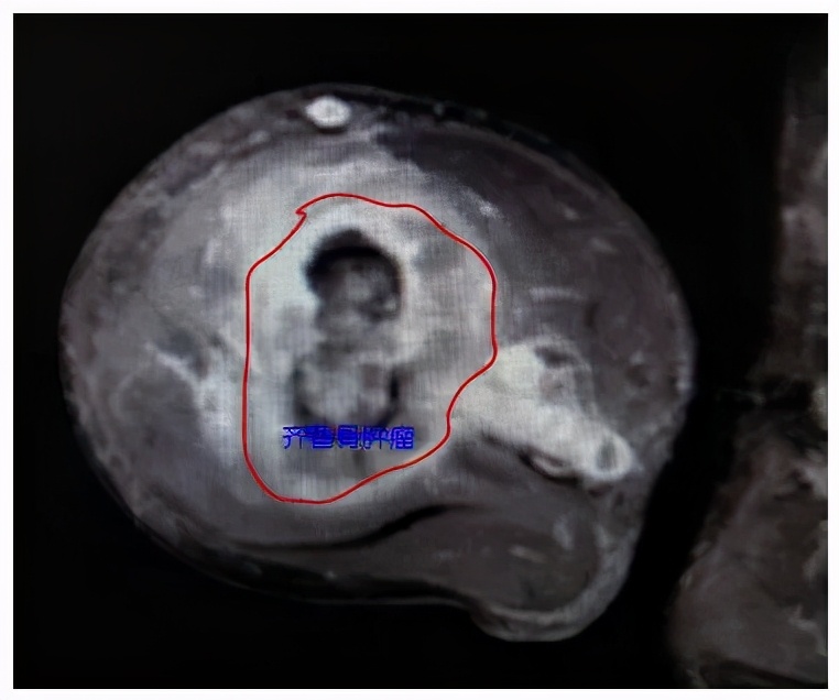 山东齐鲁医院青岛院区射频消融术,齐鲁医院等离子消融术