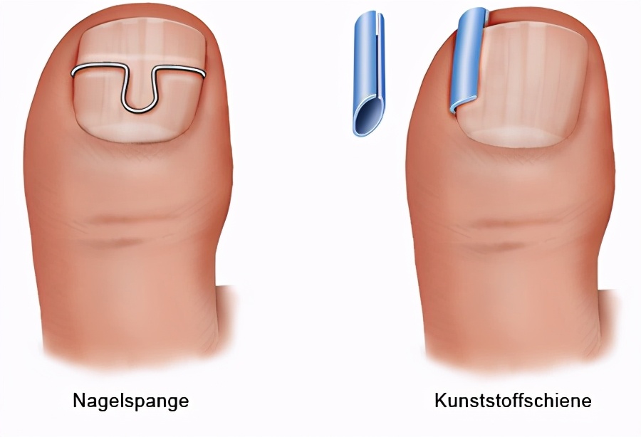 反复发作的甲沟炎应考虑什么疾病,甲沟炎注意事项及禁忌