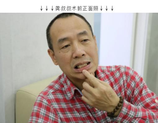 缺牙处牙槽骨萎缩邻牙受影响,60岁老人缺牙怎么治疗好