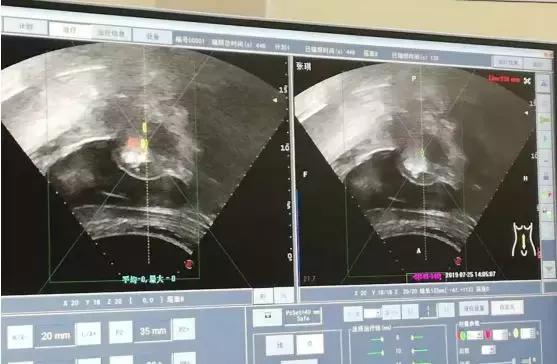 赞！不开刀不流血就把手术做了，赤峰市肿瘤医院迈入微无创时代