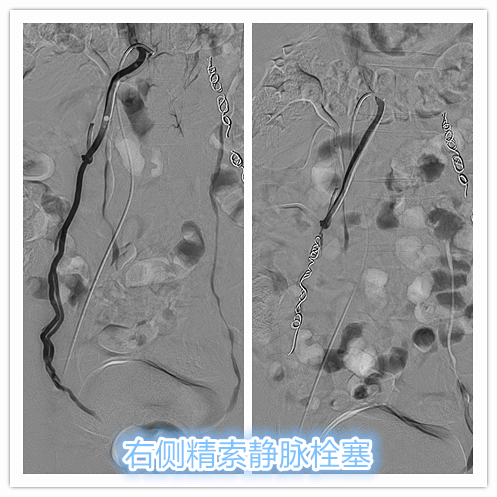 精索静脉曲张介入栓塞死路一条,精索曲张介入栓塞