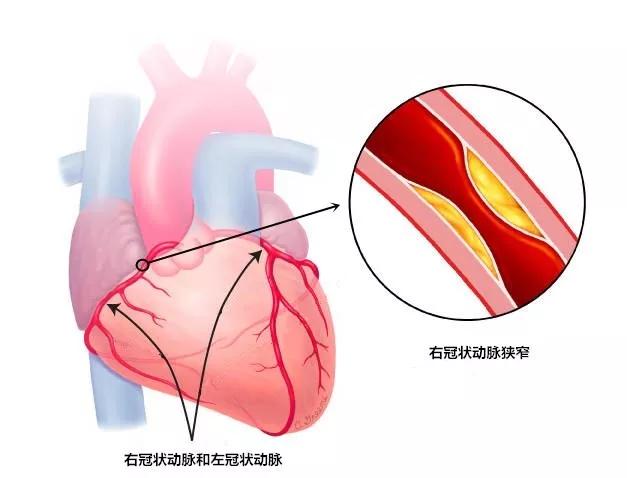 右冠状动脉闭塞多年,右冠状动脉慢性闭塞怎么治疗