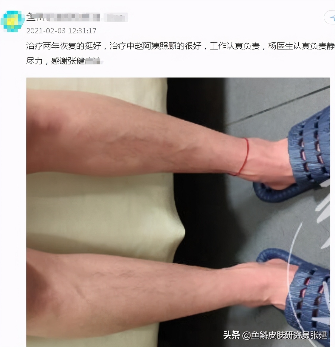 90岁老中医治鱼鳞病,中医实战笔记鱼鳞病