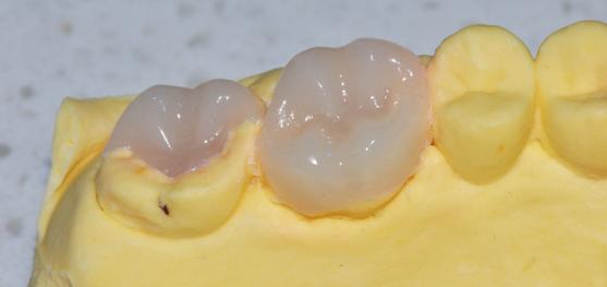 严重的蛀牙怎么修复,轻微的蛀牙修复全过程