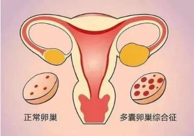 不可忽视的多囊卵巢综合征并发症,pcos多囊卵巢综合征最常见并发症