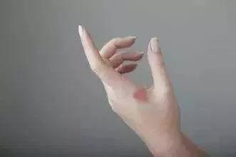 一块钱的红霉素眼膏,1-2块钱的红霉素眼膏长什么样