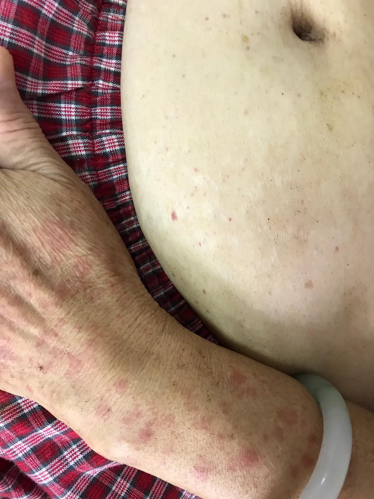 过敏性紫癜怎么治疗,过敏性紫癜