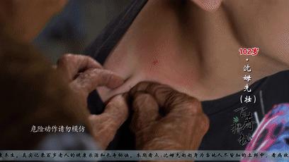 老奶奶打痧放血,100岁奶奶用针刺刮痧