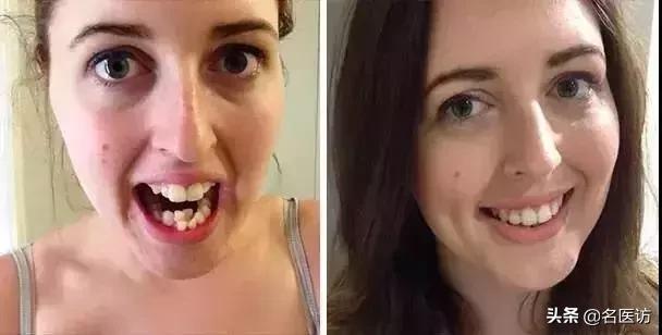 牙齿矫正换脸视频,牙齿矫正颜值有多大改变图片