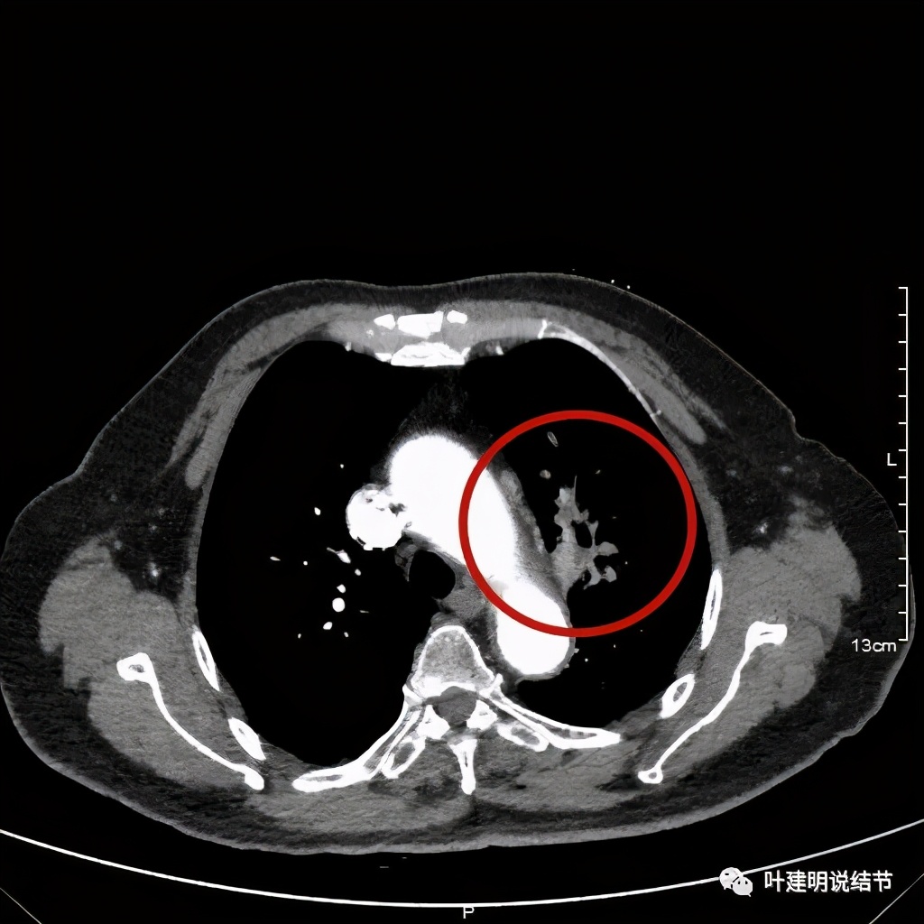 卡瑞利珠单抗治疗肺鳞癌有用吗,特瑞普利单抗对鳞癌治疗有效吗