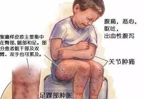 家长疑虑:什么是小儿过敏性紫癜?我们都没有听说过这种疾病