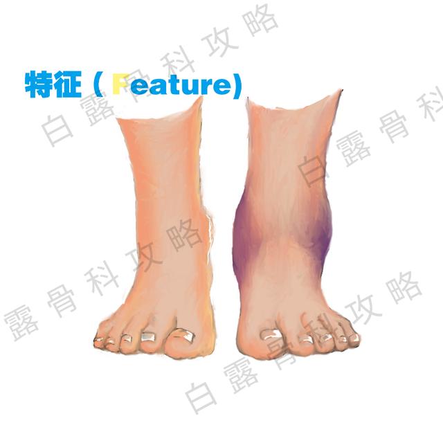 崴脚急诊能处理吗,疫情在家崴脚怎么处理