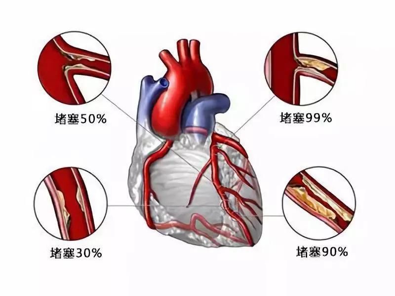 一文看懂心绞痛，个性化用药事半功倍，让你心里有数