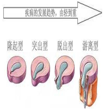 腰突压迫神经导致脚疼怎么办,脚痛无法形容的痛