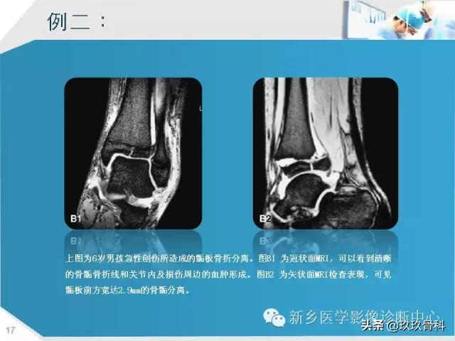 骨骺损伤x线表现,骨骺损伤磁共振表现
