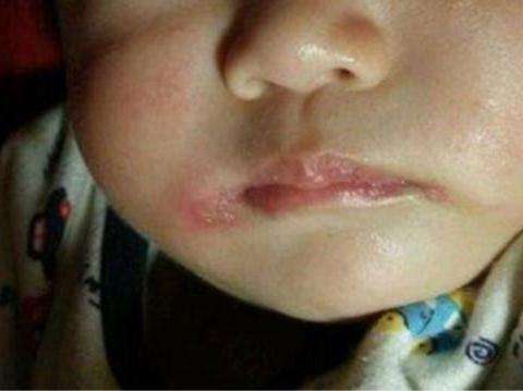 宝宝烂嘴角怎样好得快,宝宝烂嘴角用什么药好得快